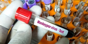 Wabah Tak Biasa, Infeksi Virus Cacar Monyet Menyebar Pesat di Eropa dan Amerika Serikat